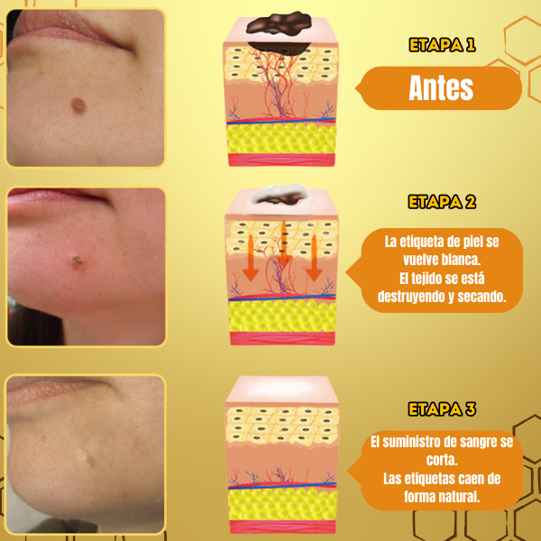 BeePure™ - Tratamiento de 7 Días para la Eliminacion de Verrugas 🐝